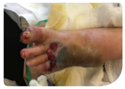 Figure A: Wound at presentation