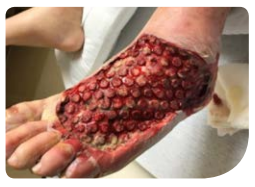Figure C: Wound after first V.A.C VERAFLO CLEANSE CHOICETM